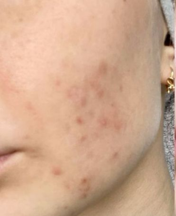 Sensitive Skin - Before