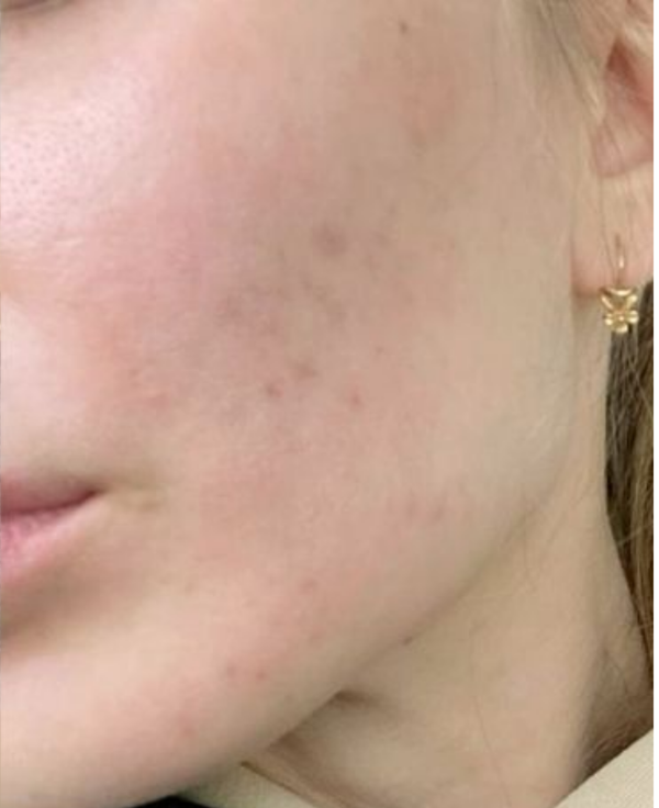 Sensitive Skin - After